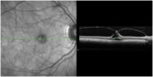 Vitreomacular Adhesion Vision Example