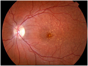 Macular Degeneration Example